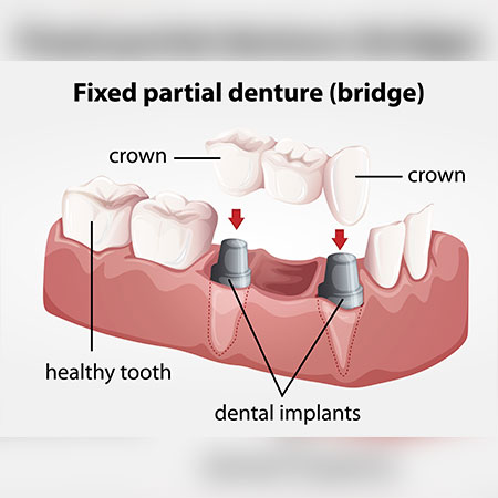 Types of Partial Denture