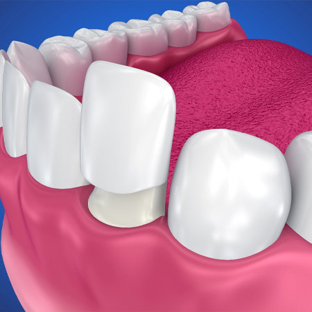 Indications Of Dental Veneers